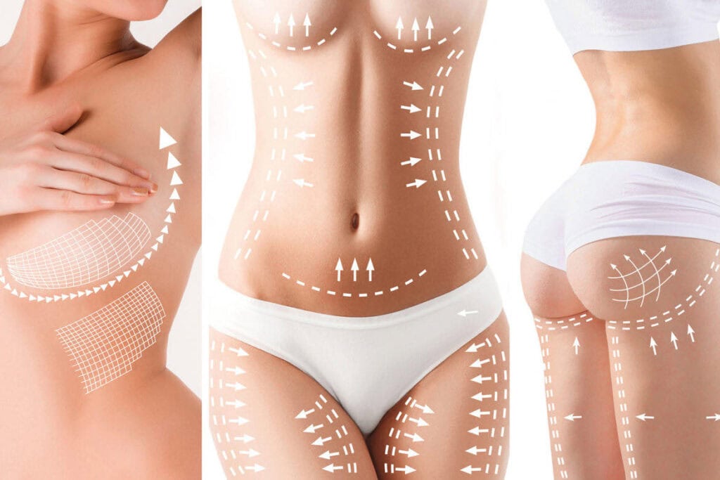 Body contouring treatment illustration with markings on abdomen, waist, and hips.