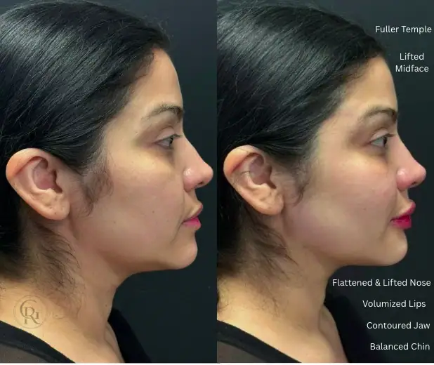 Before and after facial balancing treatment in Houston, TX.