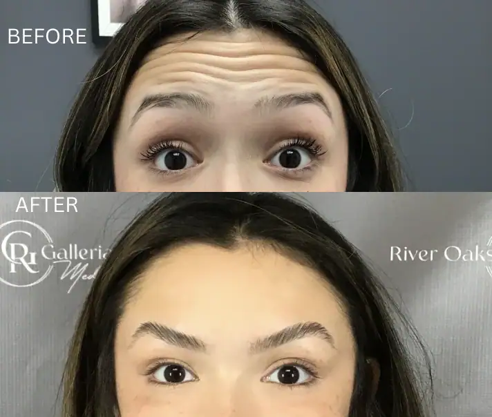 Botox before and after images showing reduced forehead wrinkles and smoother skin.