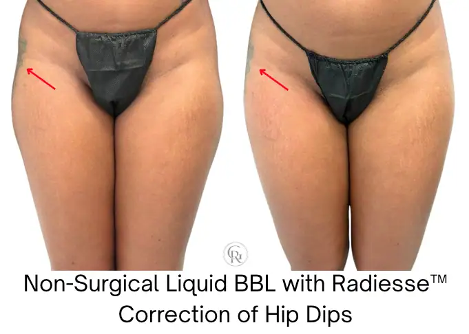 Non-Surgical Liquid BBL with Radiesse™ correction of hip dips.