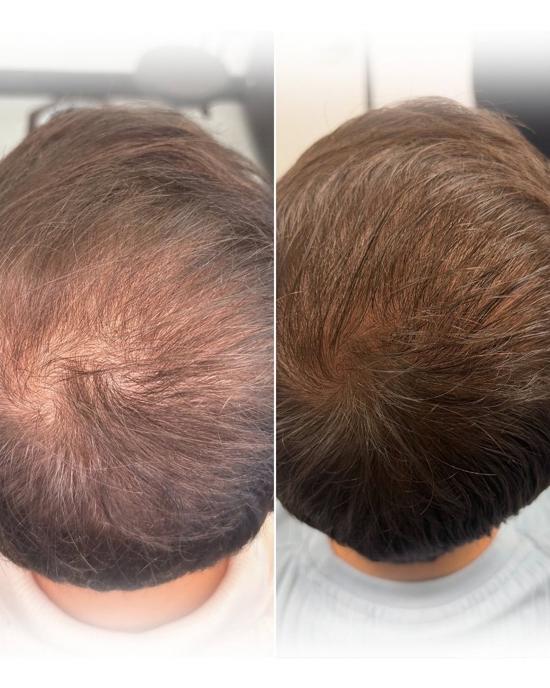 ROG Med Spa Before After hair Restoration