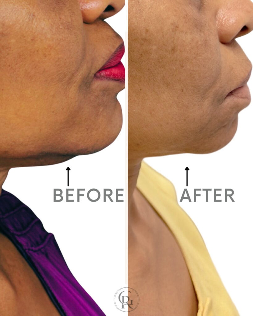 Sofwave Before & After Double Chin Skin Tightening ROG Medspa