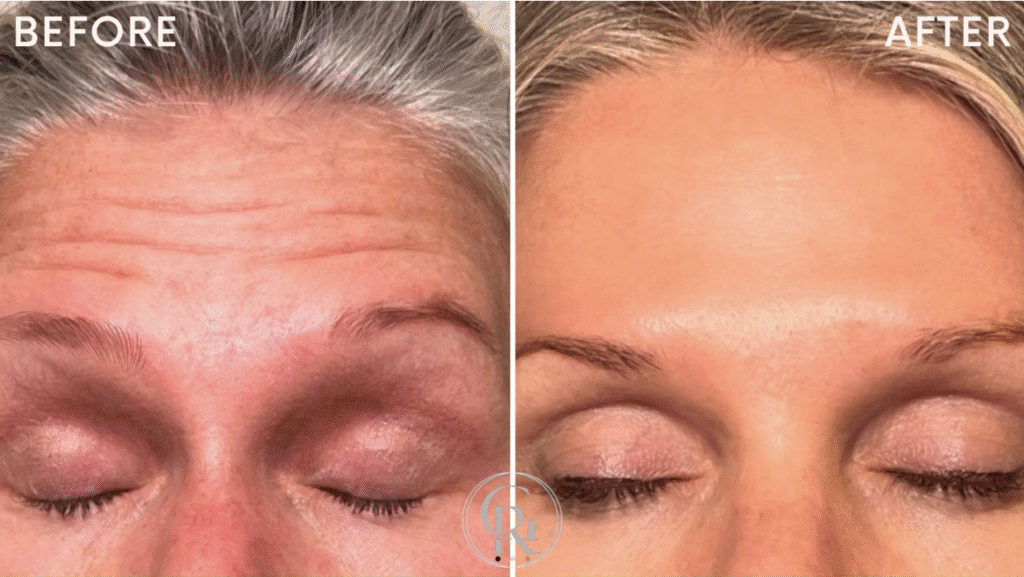 Filler + Tox before after 1
