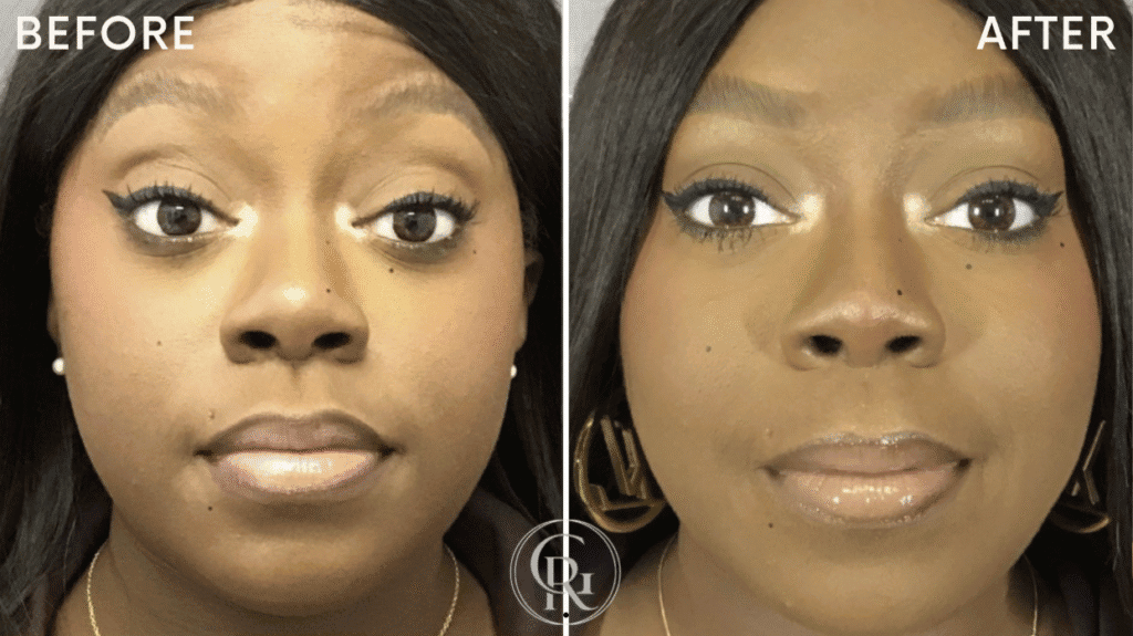 Filler + Tox before after 2