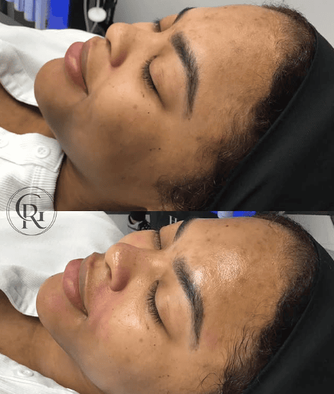 HydraFacial Before After 2