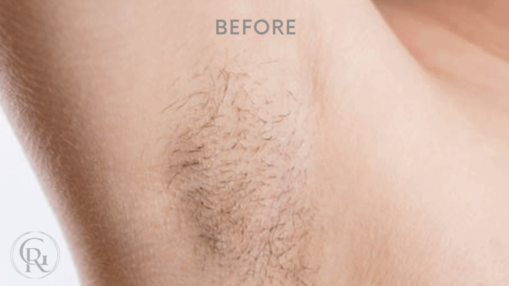 Laser Removal Before