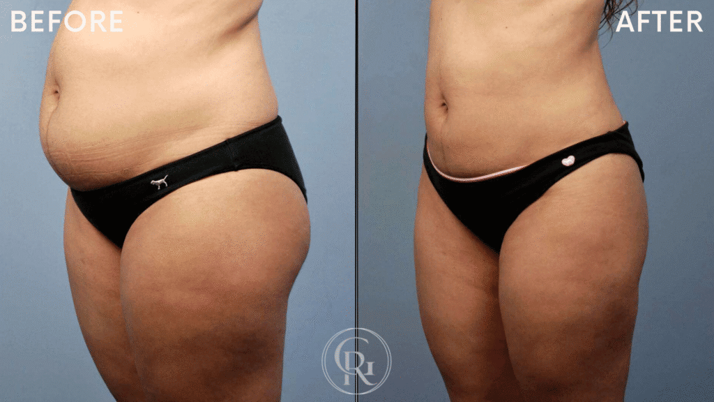 body contour before after 1