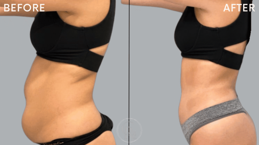 body contour before after 2