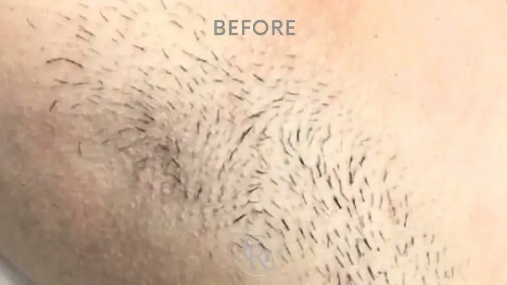 laser removal before 2