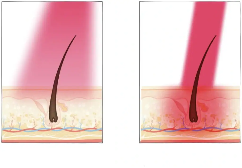 LLLT vs LED Light Therapy comparison