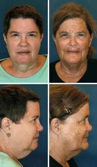 Identical twins from a landmark photoaging study showing visible differences in wrinkles, pigmentation, and skin aging associated with long-term sun exposure and inconsistent sunscreen use.