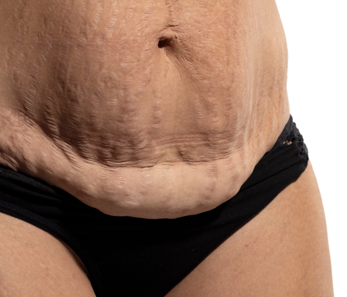 ROG mommy makeover, mom stomach